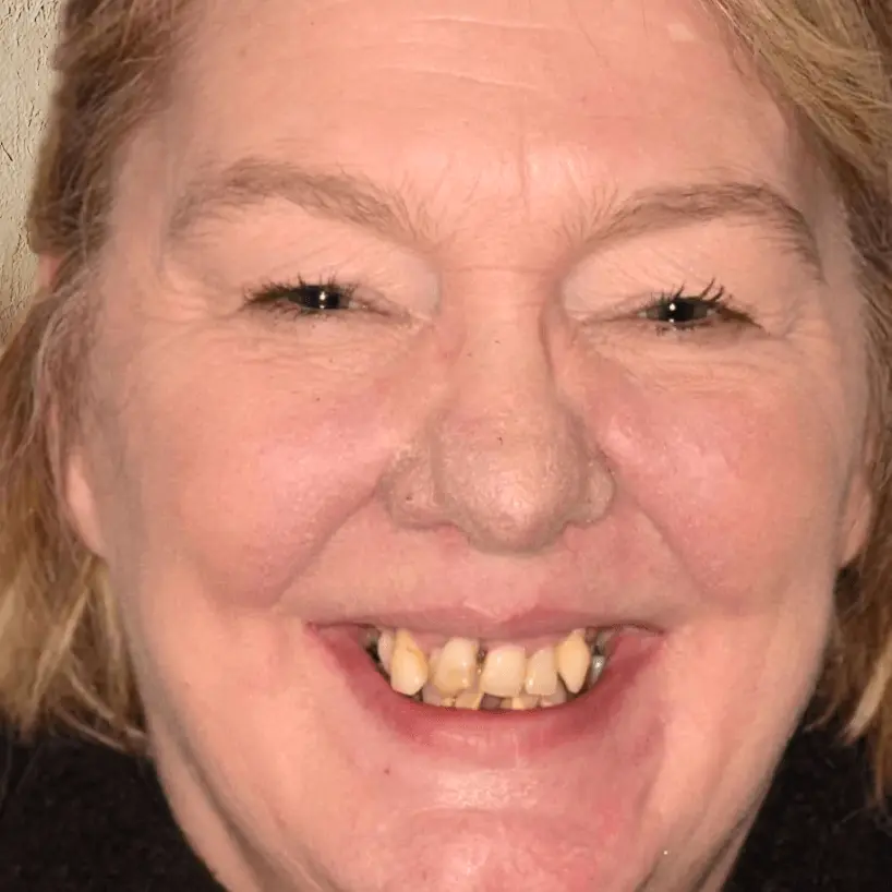 Close-up of a smiling woman with visible misaligned and discolored teeth.