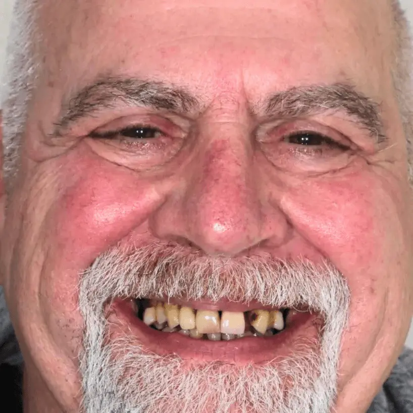 Close-up of an elderly man smiling, showing yellowed and decayed teeth with gaps.