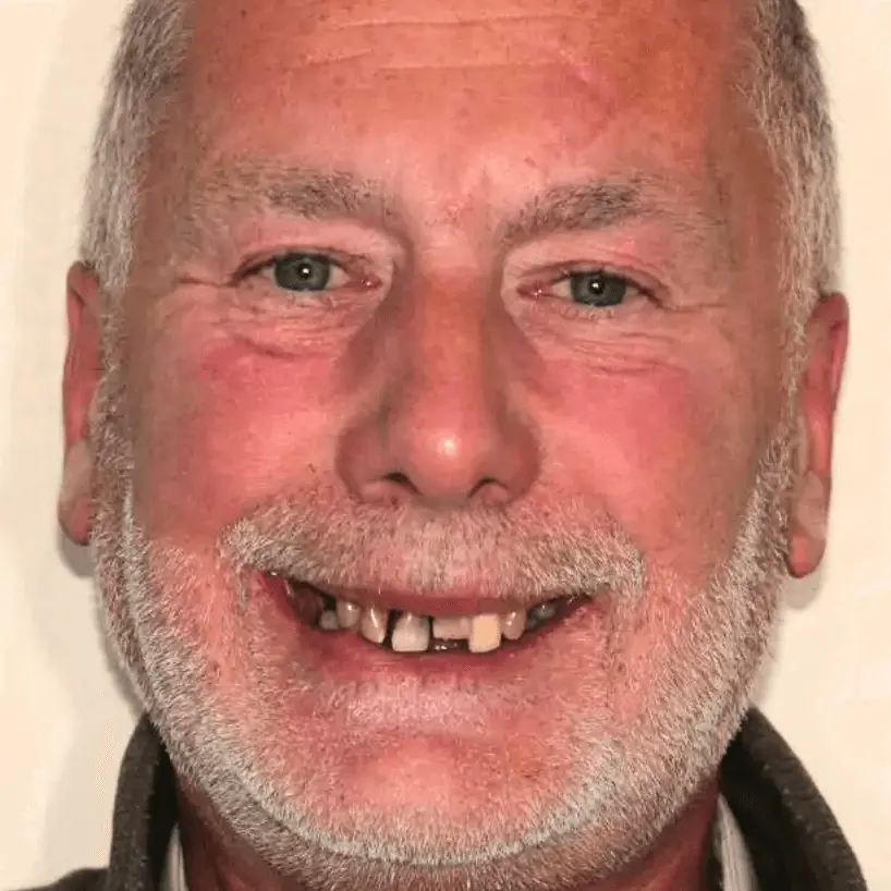 Older man with gray beard and missing front teeth smiling at the camera.