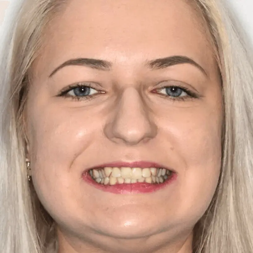 Close-up of a woman with blonde hair smiling, showing her teeth with a slight overbite.