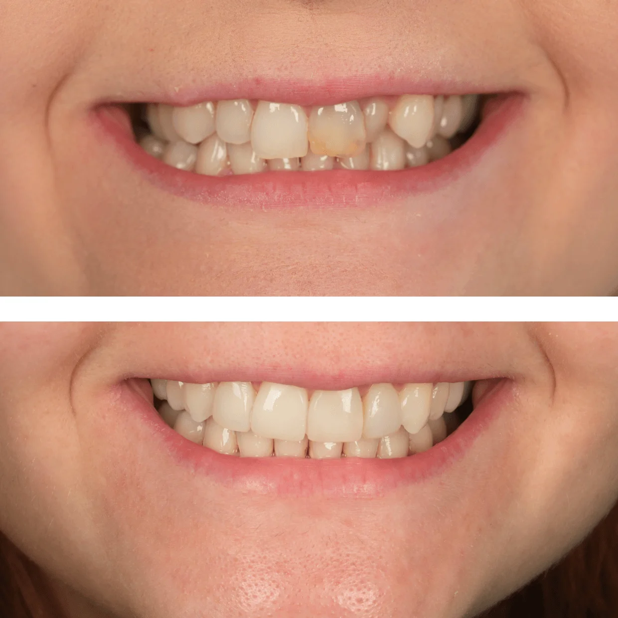 Close-up comparison of a smile showing teeth before and after dental treatment, with visible discoloration on a front tooth in the before image and a clean, white smile in the after image.