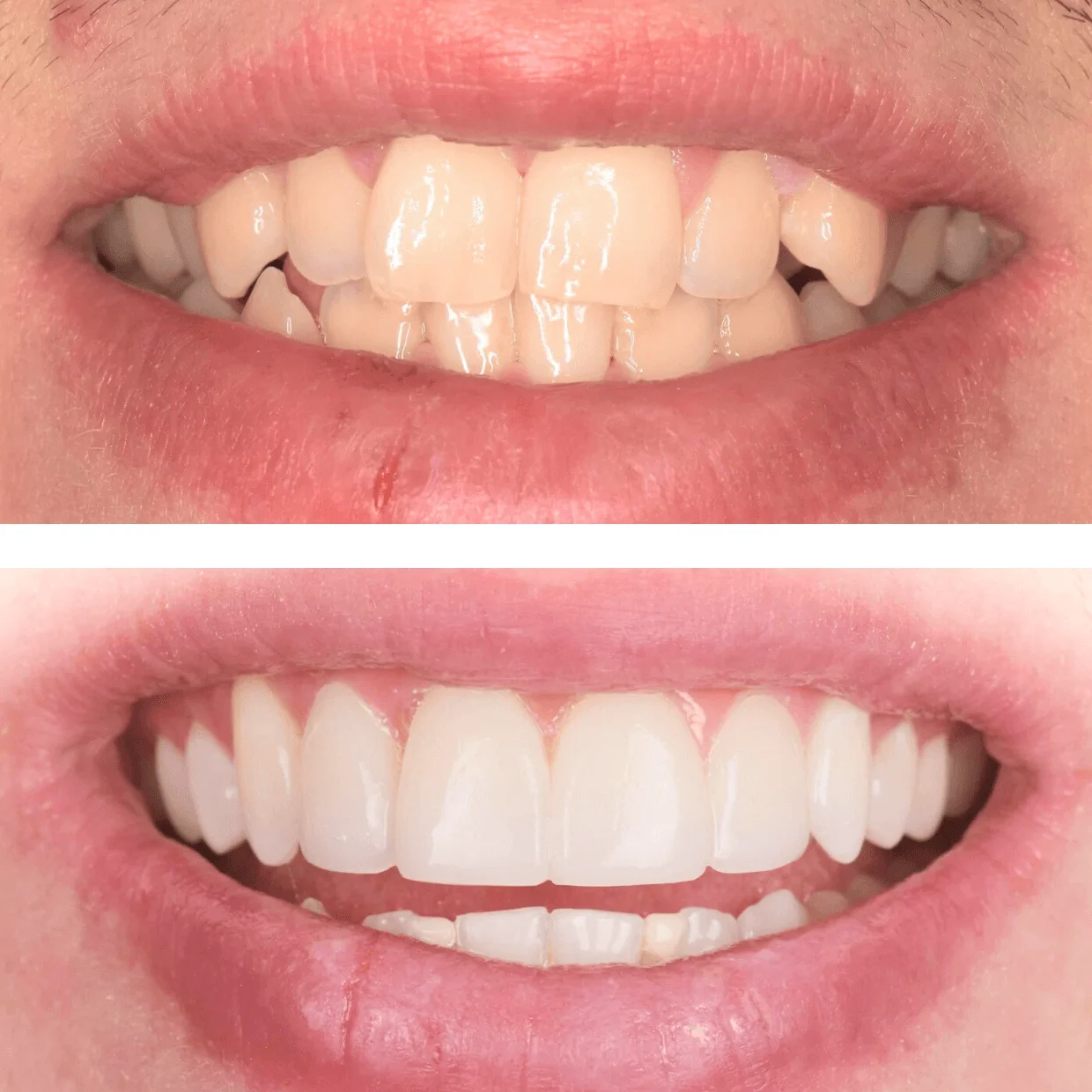 Close-up comparison of a person's smile before and after dental treatment showing misaligned teeth corrected to straight, white teeth.