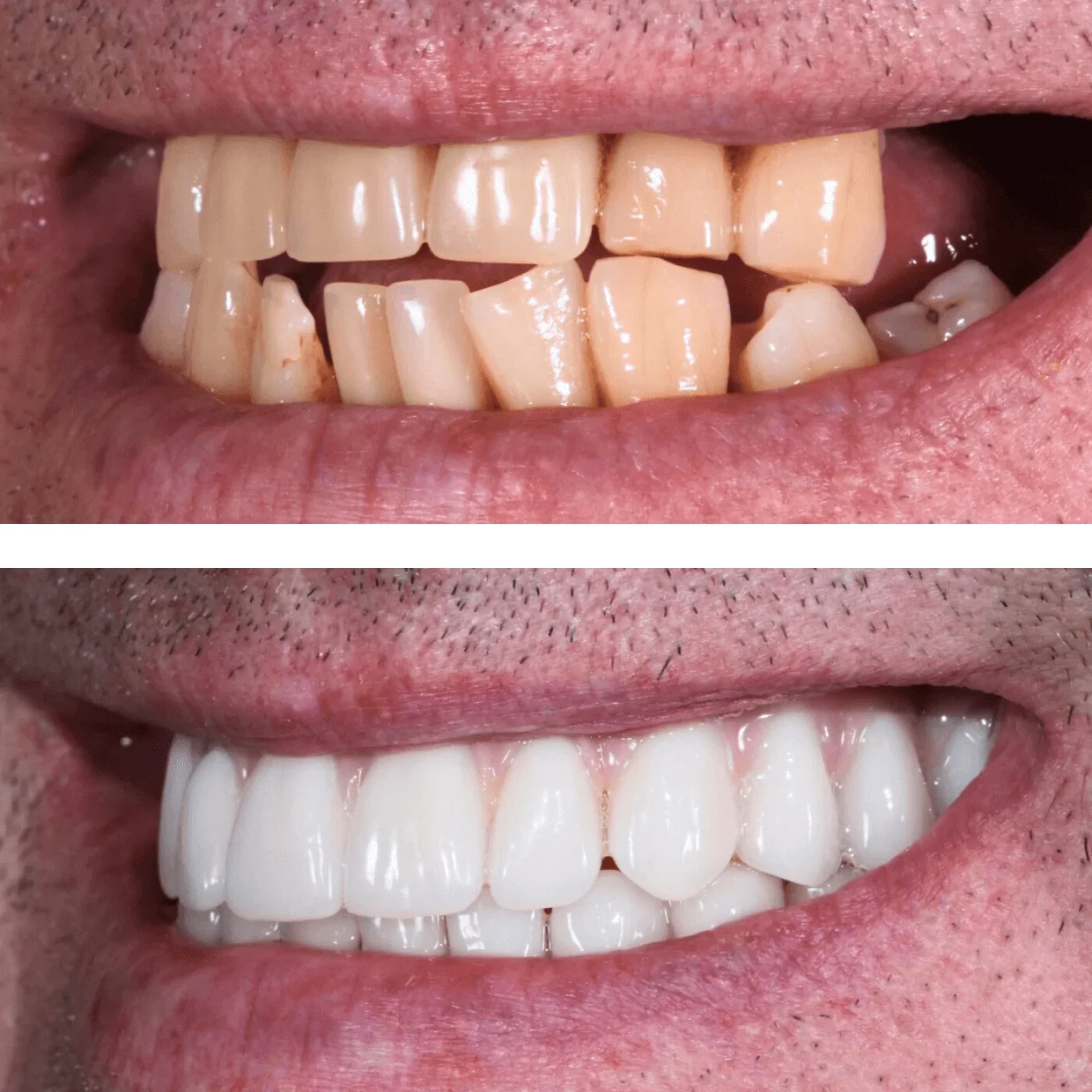 Close-up of a person's mouth showing damaged, yellowed teeth in the top image and a bright, even white smile after dental restoration in the bottom image.