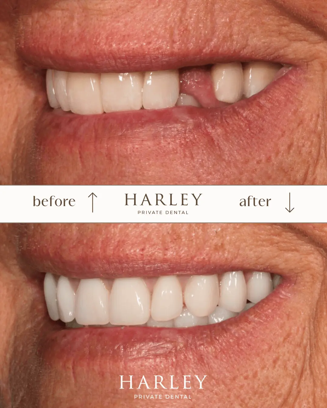 Close-up split image showing a before and after comparison of a person's teeth, with missing teeth visible before and a full set of white, even teeth after dental treatment.