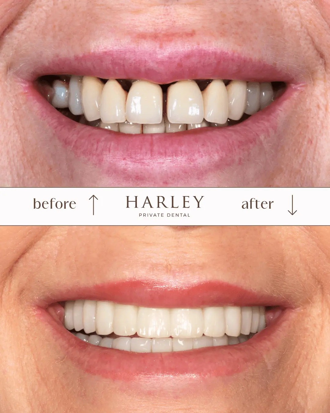 Before and after close-up photos of a smile showing dental restoration with whiter, aligned teeth after treatment.