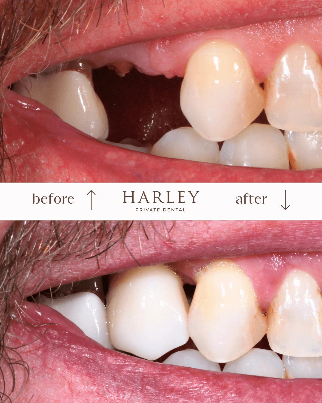Close-up dental before-and-after image showing a missing upper tooth replaced by a natural-looking dental implant.