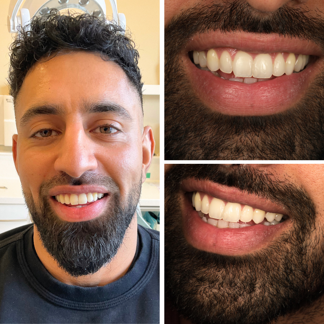 Collage of three close-up photos of a man with curly black hair and beard, smiling to show his teeth from front and side angles.