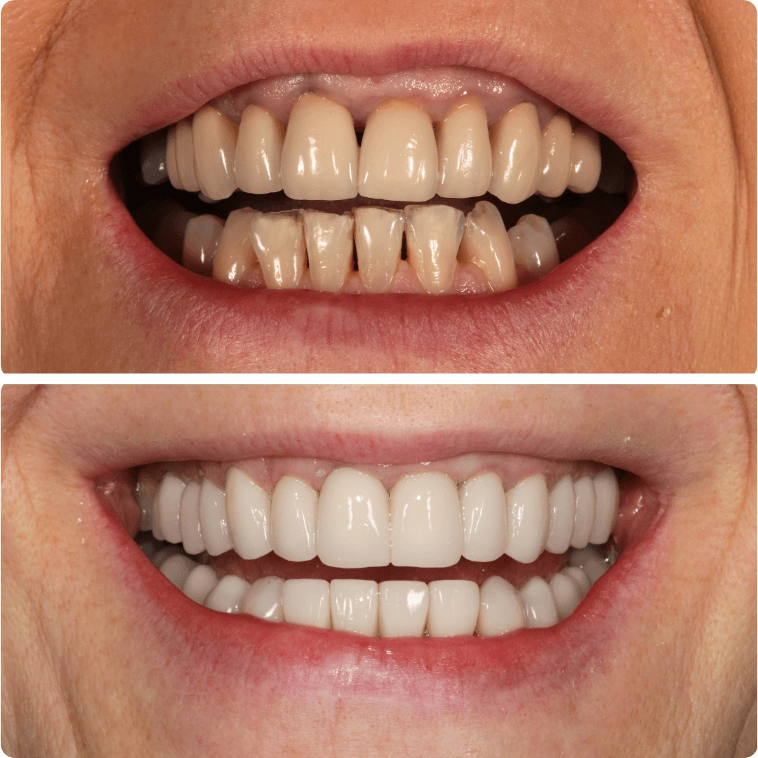 Before and after close-up of a smile showing dental composite bonding improvements with straighter and whiter teeth.