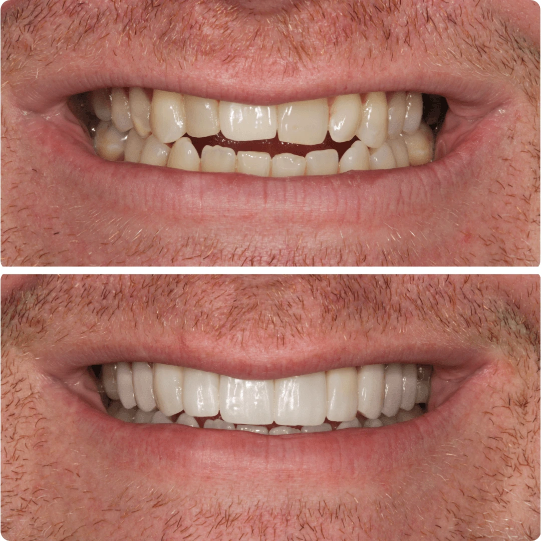 Before and after close-up of a smile showing dental improvement with whiter, even teeth after treatment.