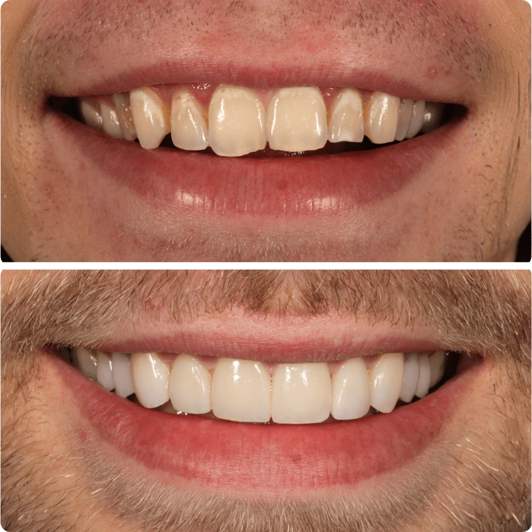 Before and after close-up of a smile showing dental bonding that corrected chipped and uneven front teeth.