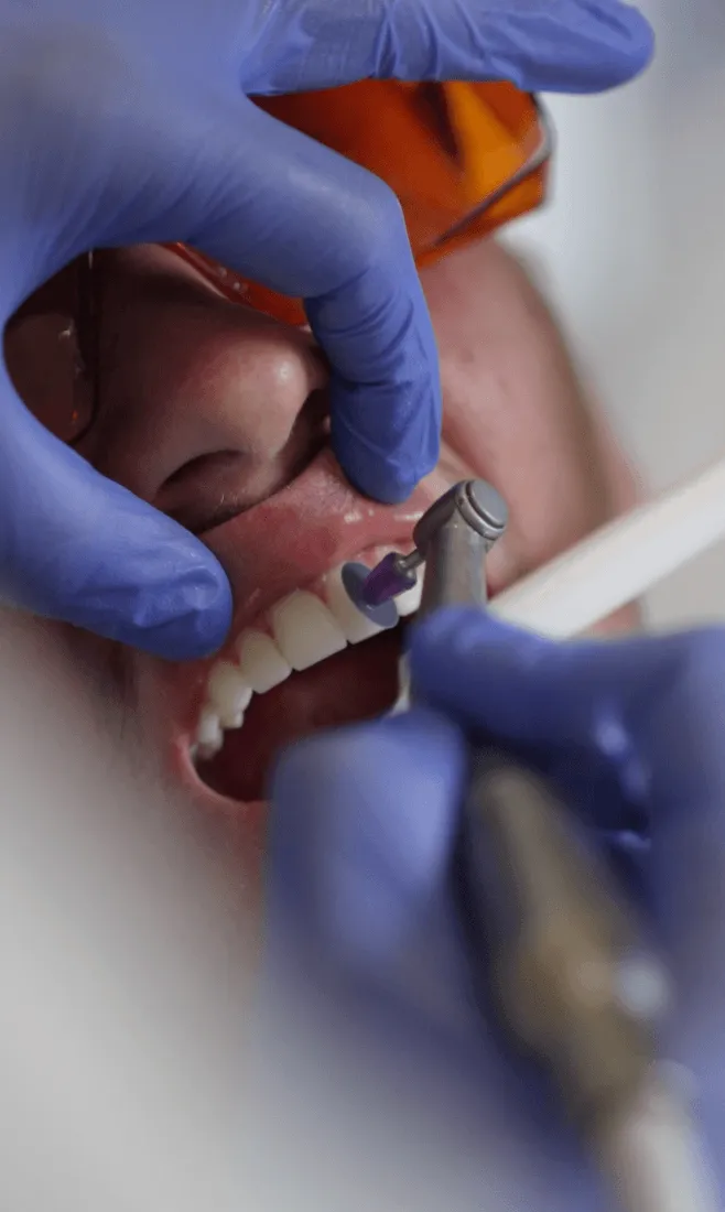 Teeth being polished during a hygiene appointment at Harley Private