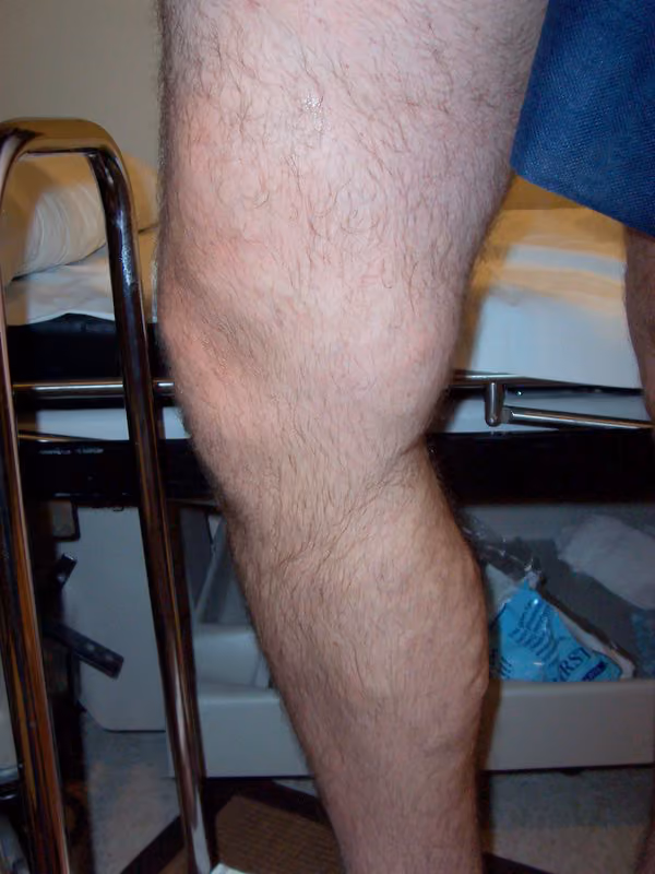 Surgical lasers