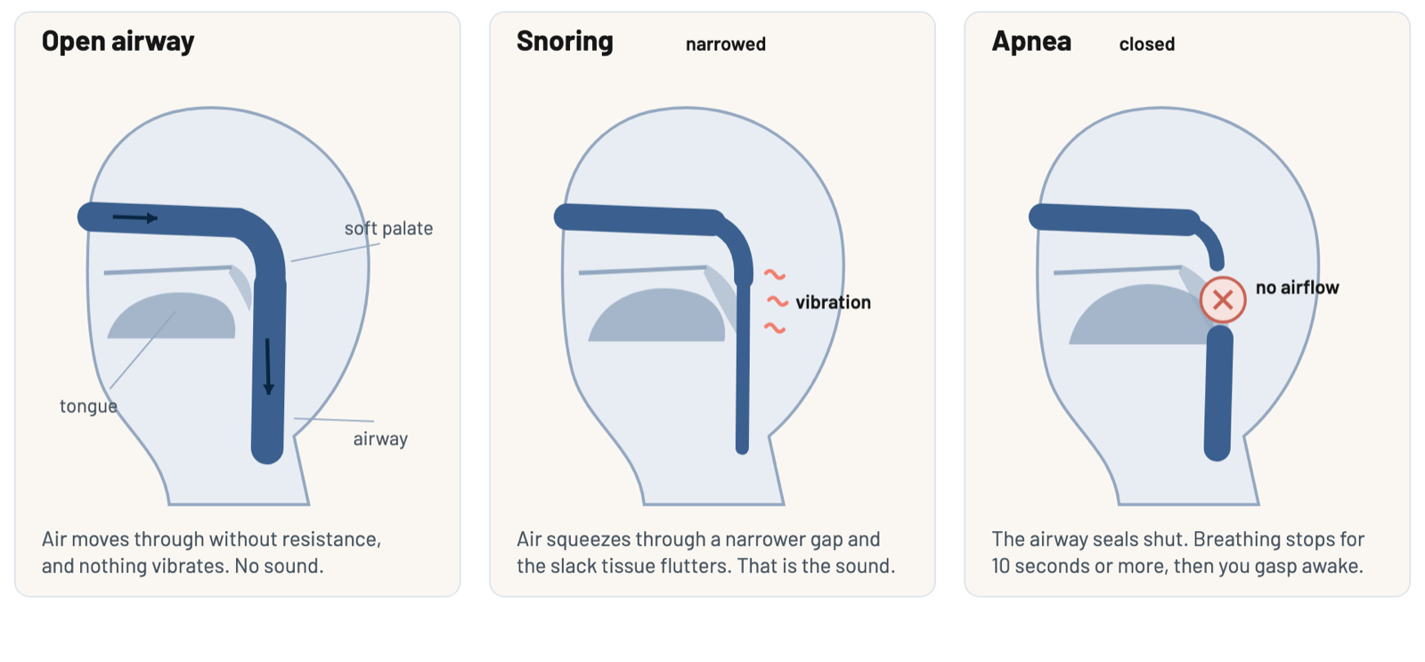Side view schematics of an open airway, a narrowed airway vibrating during snoring, and an airway fully closed during an apnea.