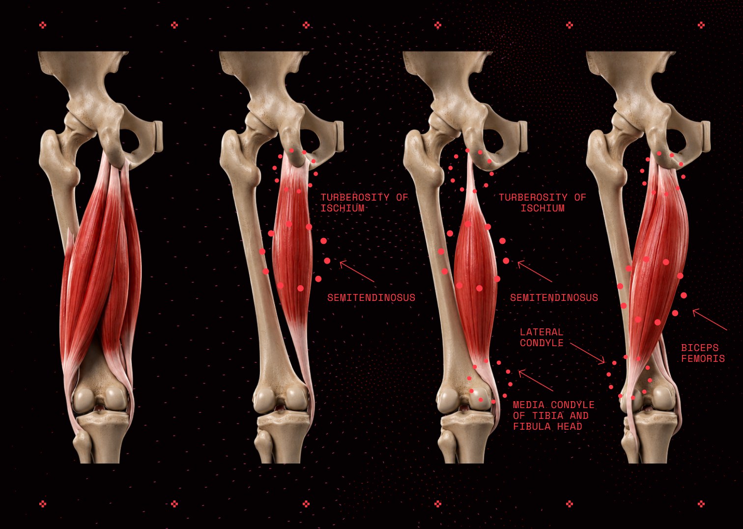 Anatomical renders of the hamstring muscles at the back of the thigh, labelling the semitendinosus, semimembranosus and biceps femoris