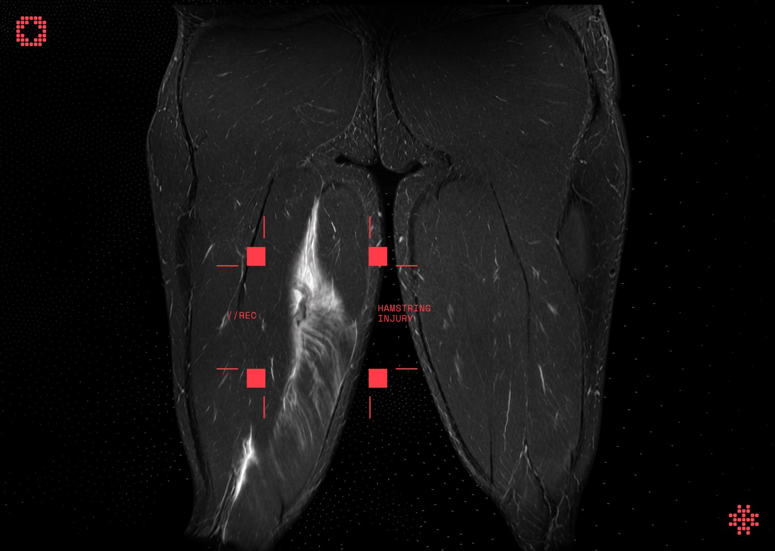 Coronal MRI of both thighs with markers highlighting a hamstring injury