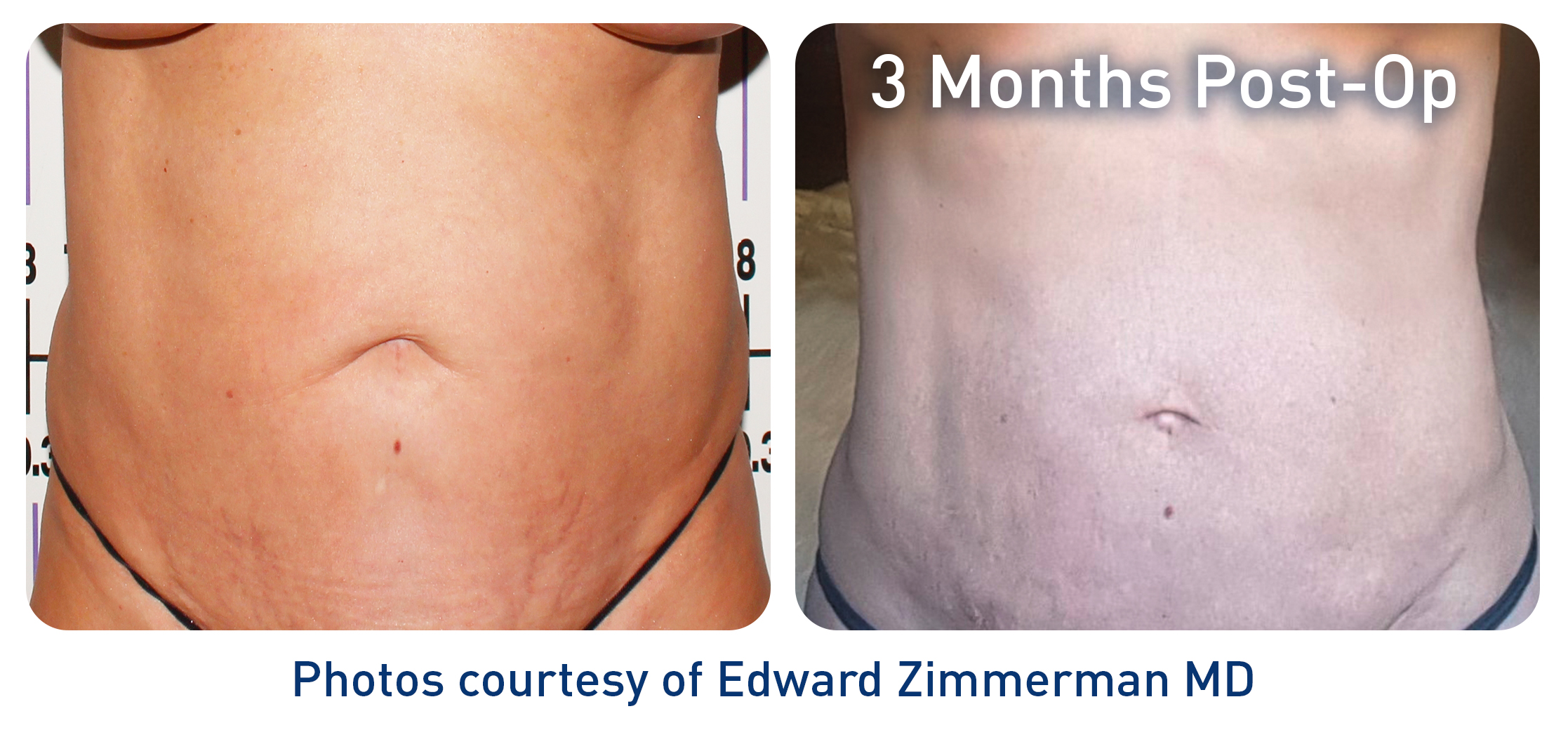 Renuvion Ergebnis Bauch 2