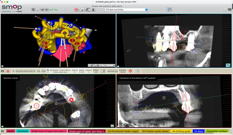 Smop digital implant planning software showing 3D and multiplanar clinical views