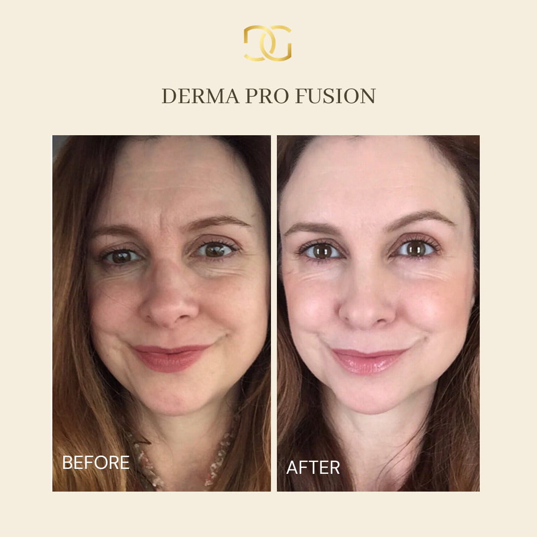 Derma Pro Fusion before and after result 4