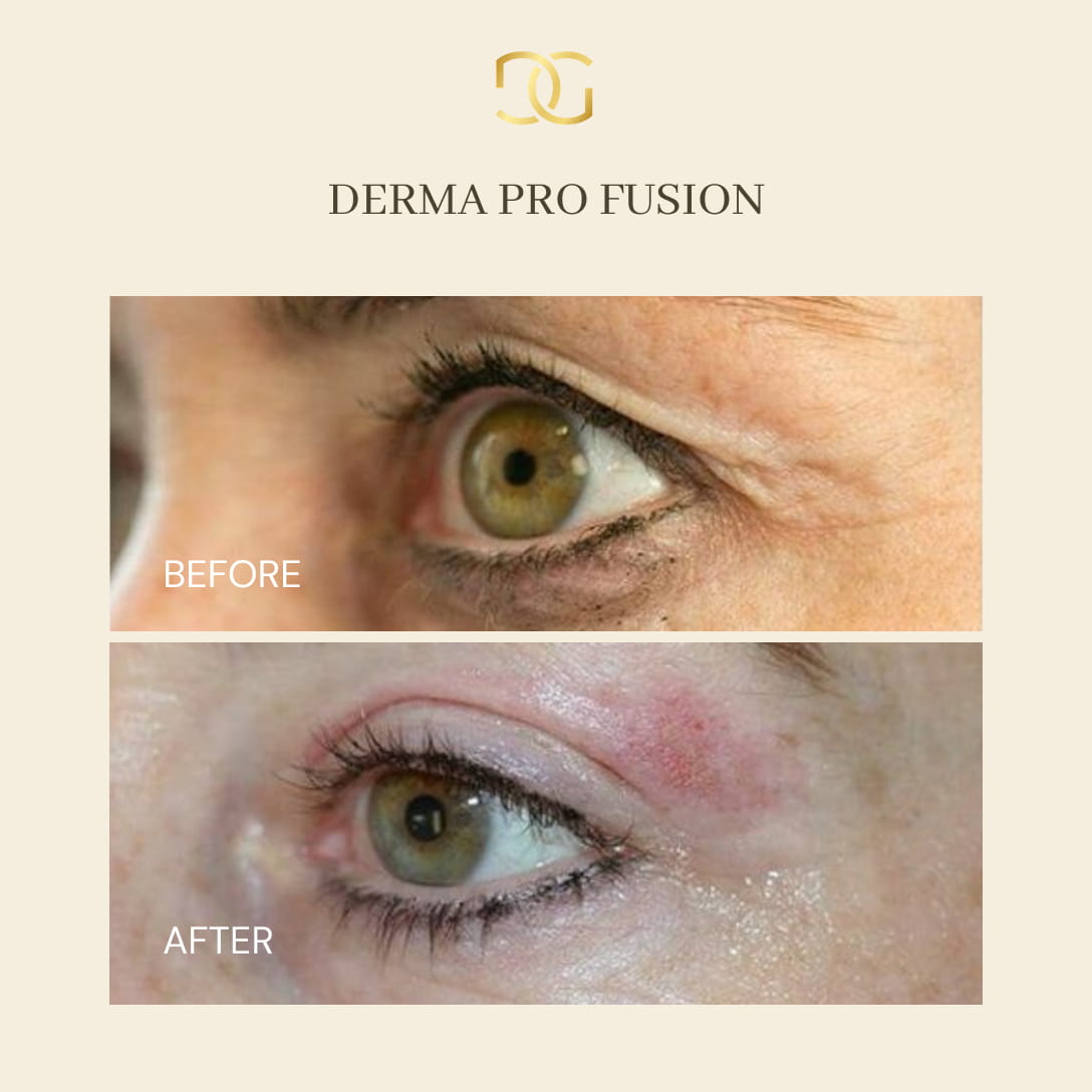 Derma Pro Fusion before and after result 2