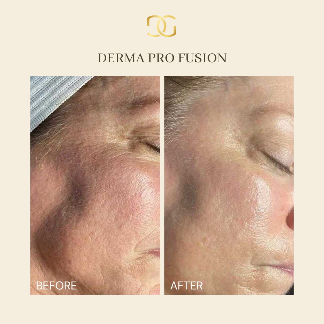 Derma Pro Fusion before and after result 1