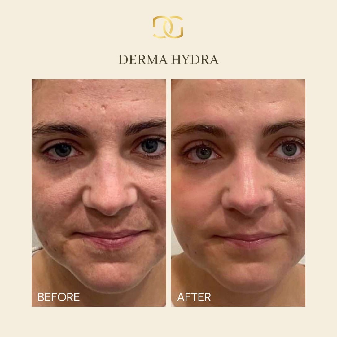 Derma Pro Fusion before and after result 3