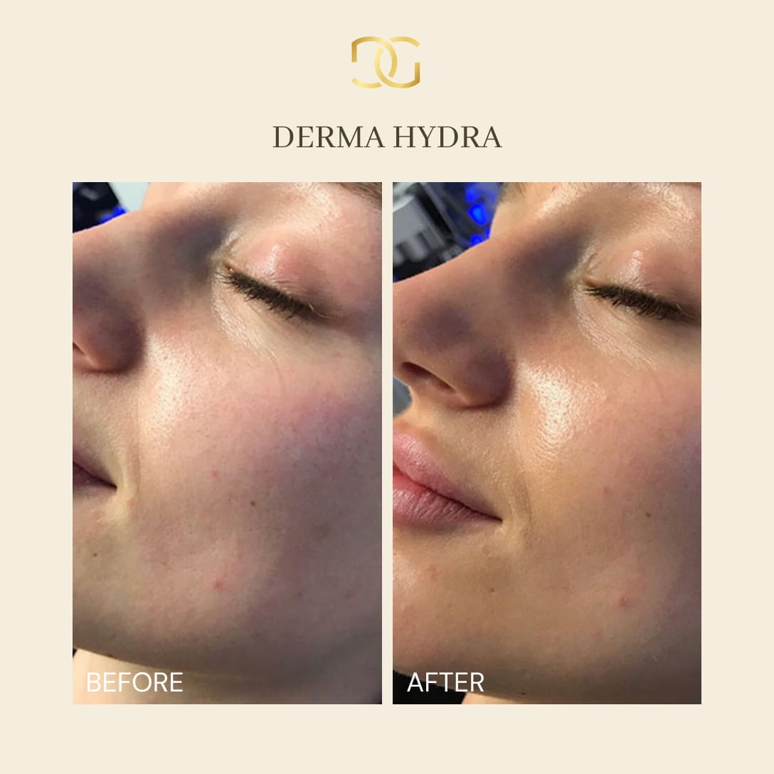 Derma Pro Fusion before and after result 2
