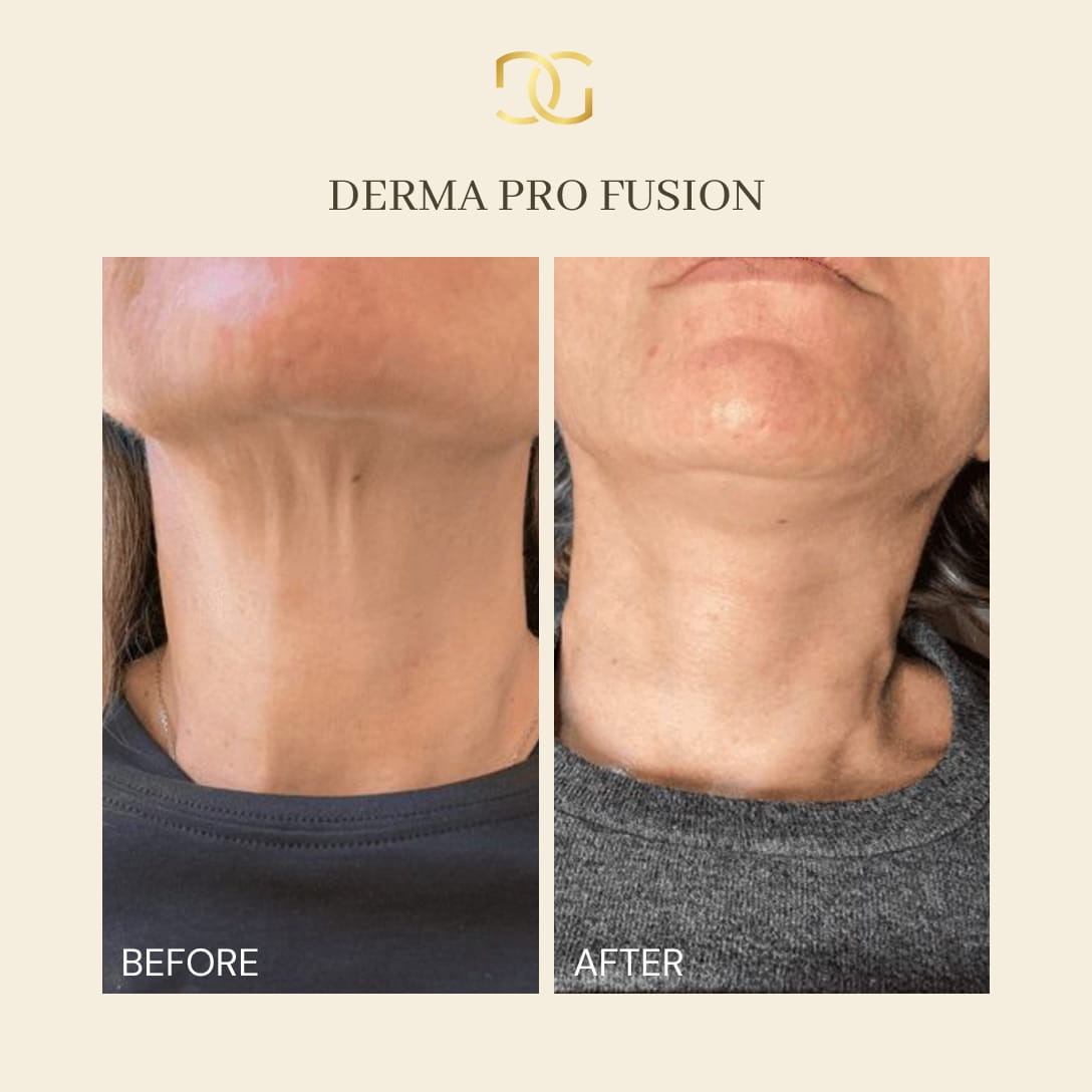 Derma Pro Fusion before and after result 3