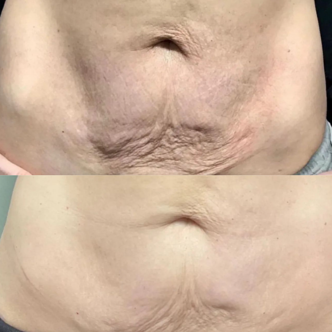 Before and after result 17
