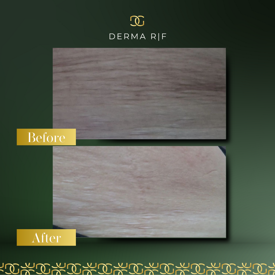 Before and after result 23