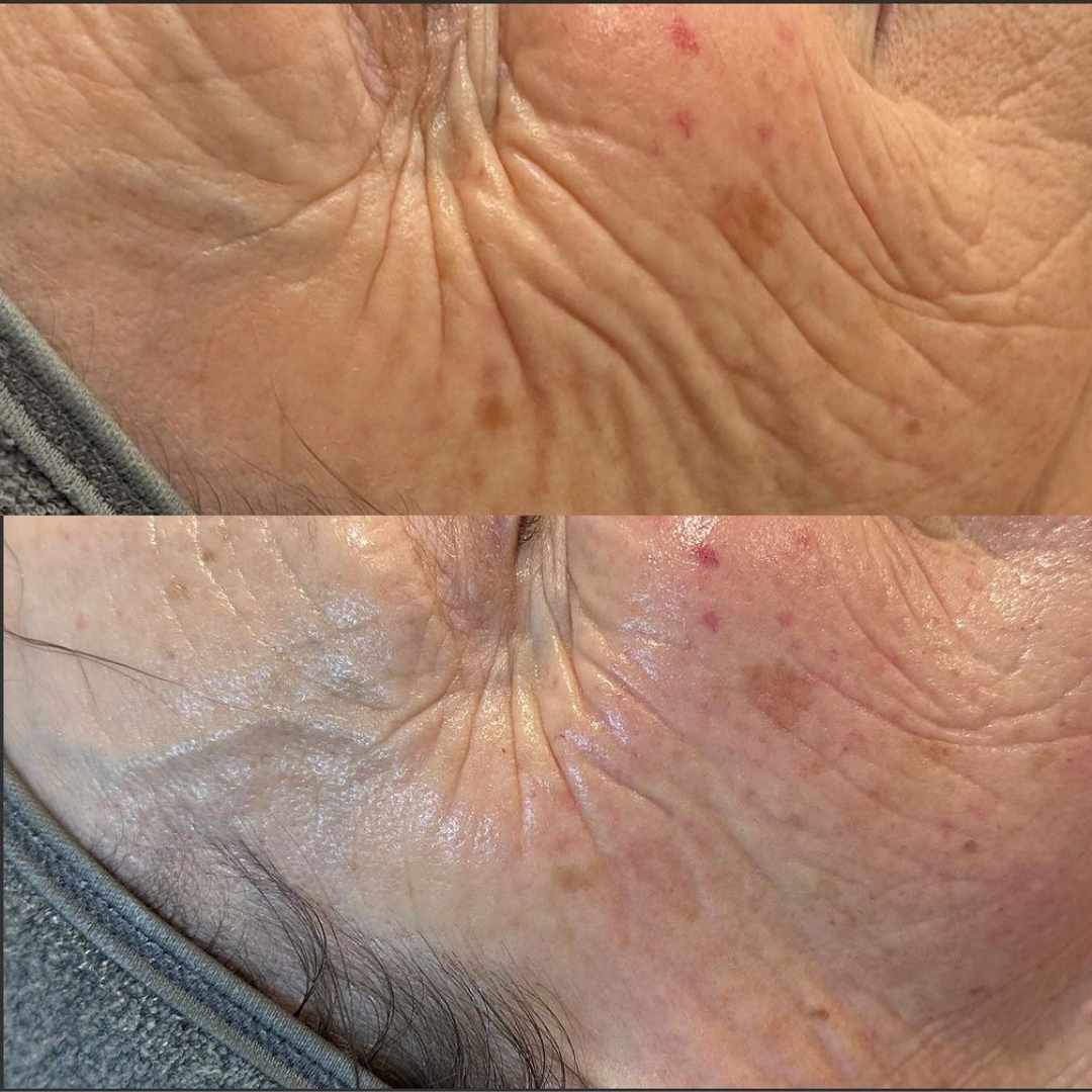 Before and after result 32