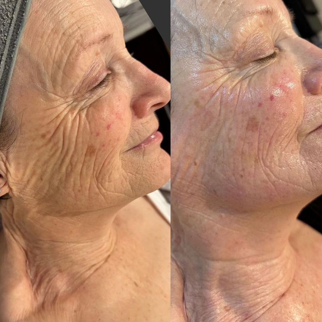 Before and after result 31