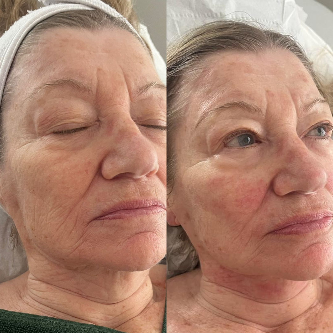 Before and after result 30