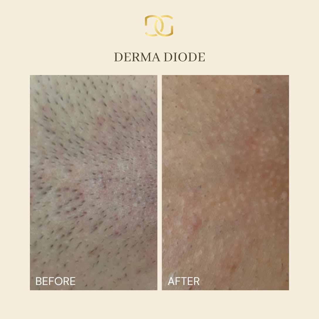 Derma Pro Fusion before and after result 1