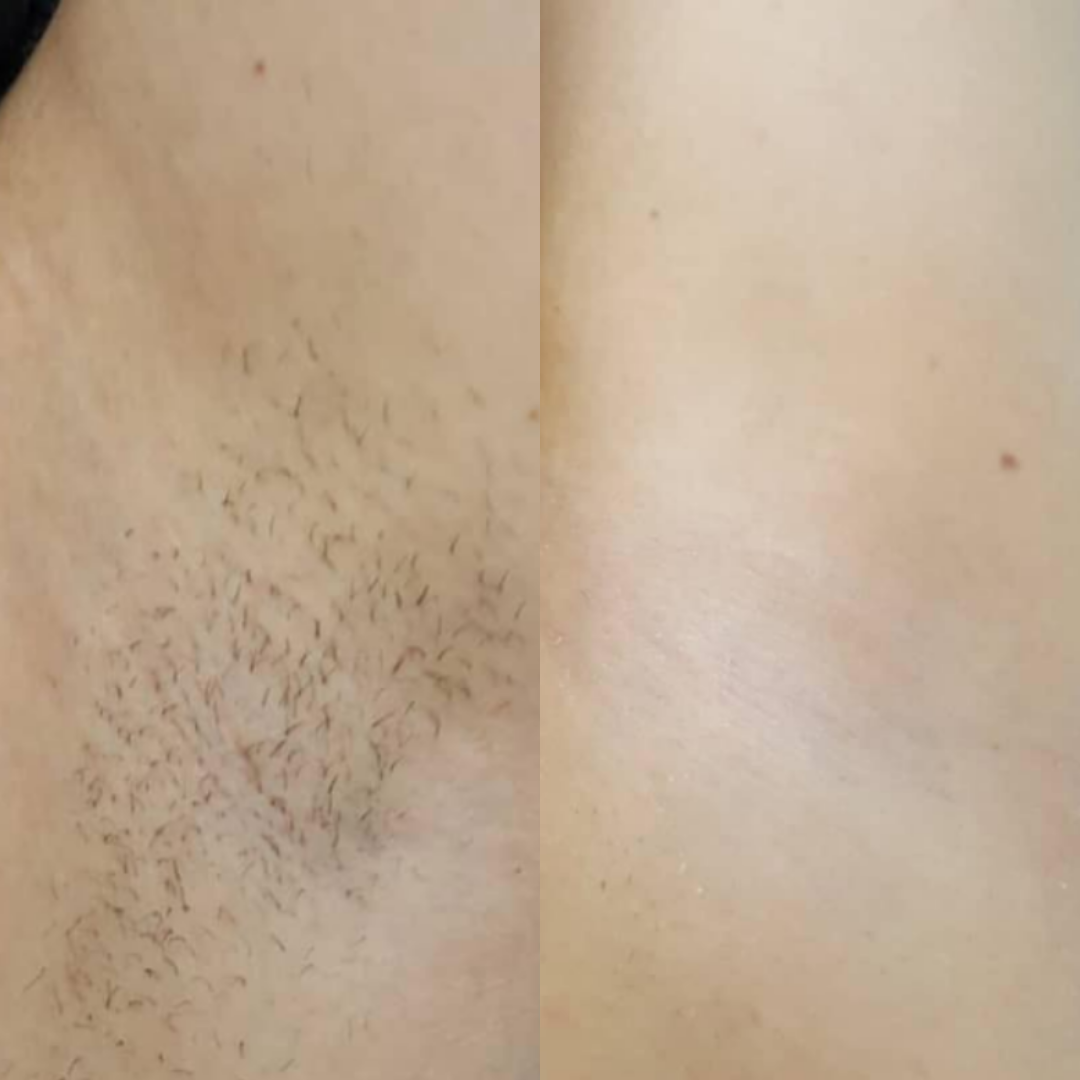 Derma Pro Fusion before and after result 3