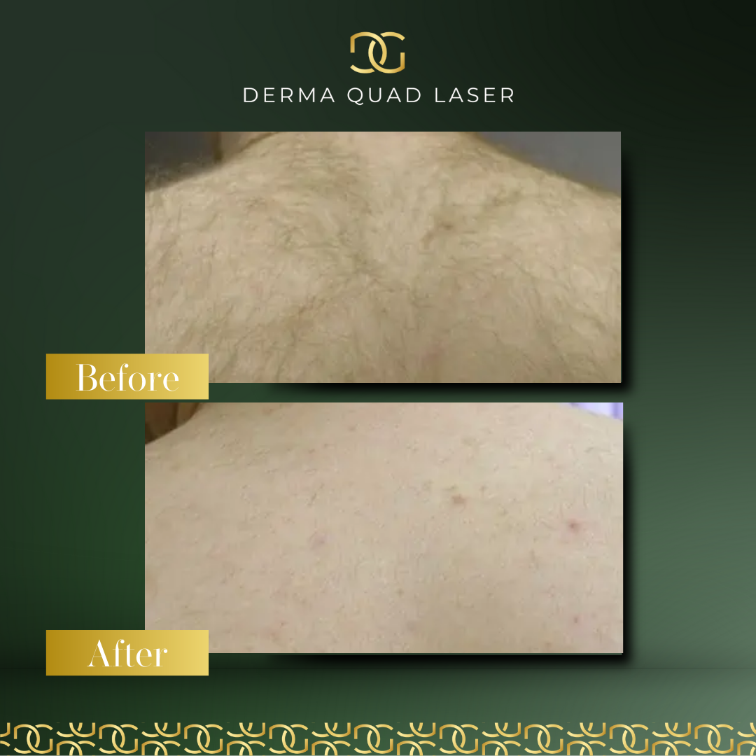 Derma Pro Fusion before and after result 3
