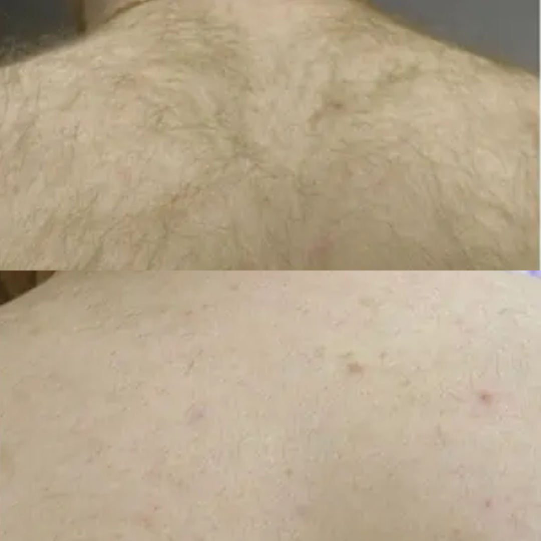 Derma Pro Fusion before and after result 3