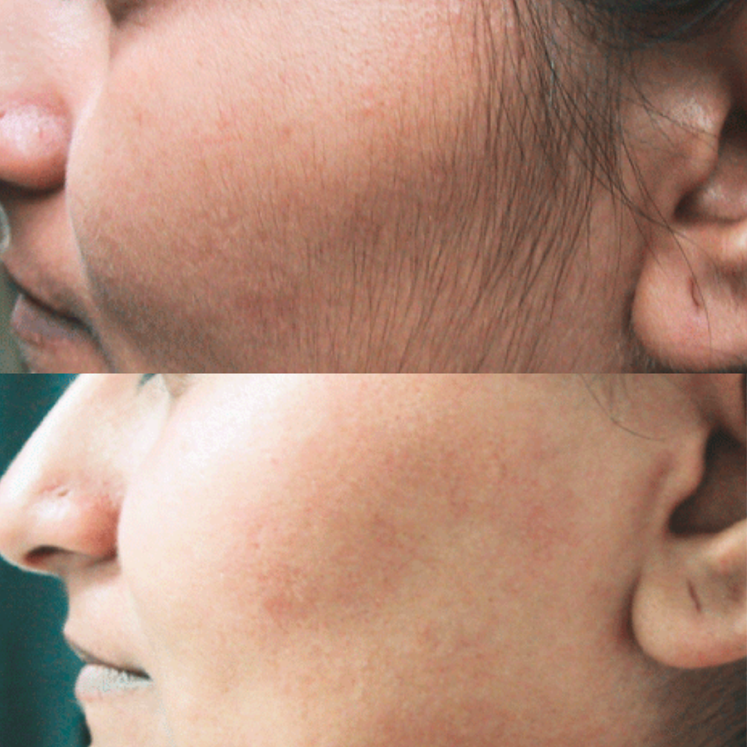 Derma Pro Fusion before and after result 1