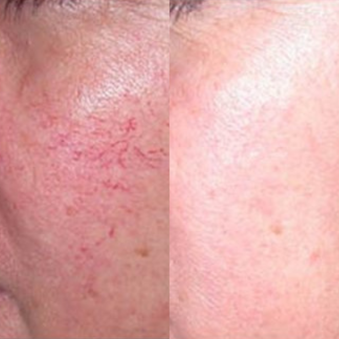 Derma Pro Fusion before and after result 4