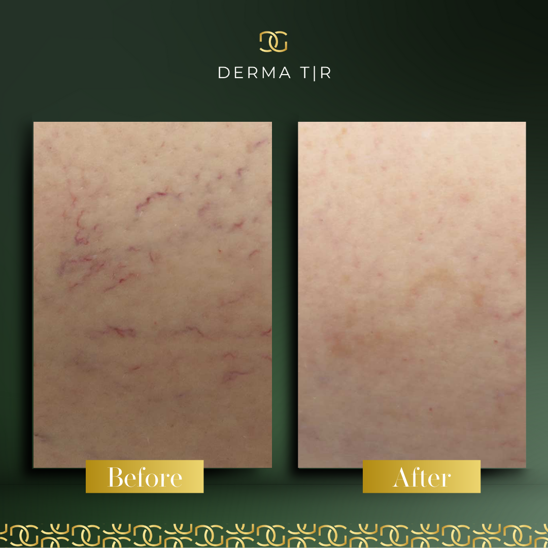 Derma Pro Fusion before and after result 4