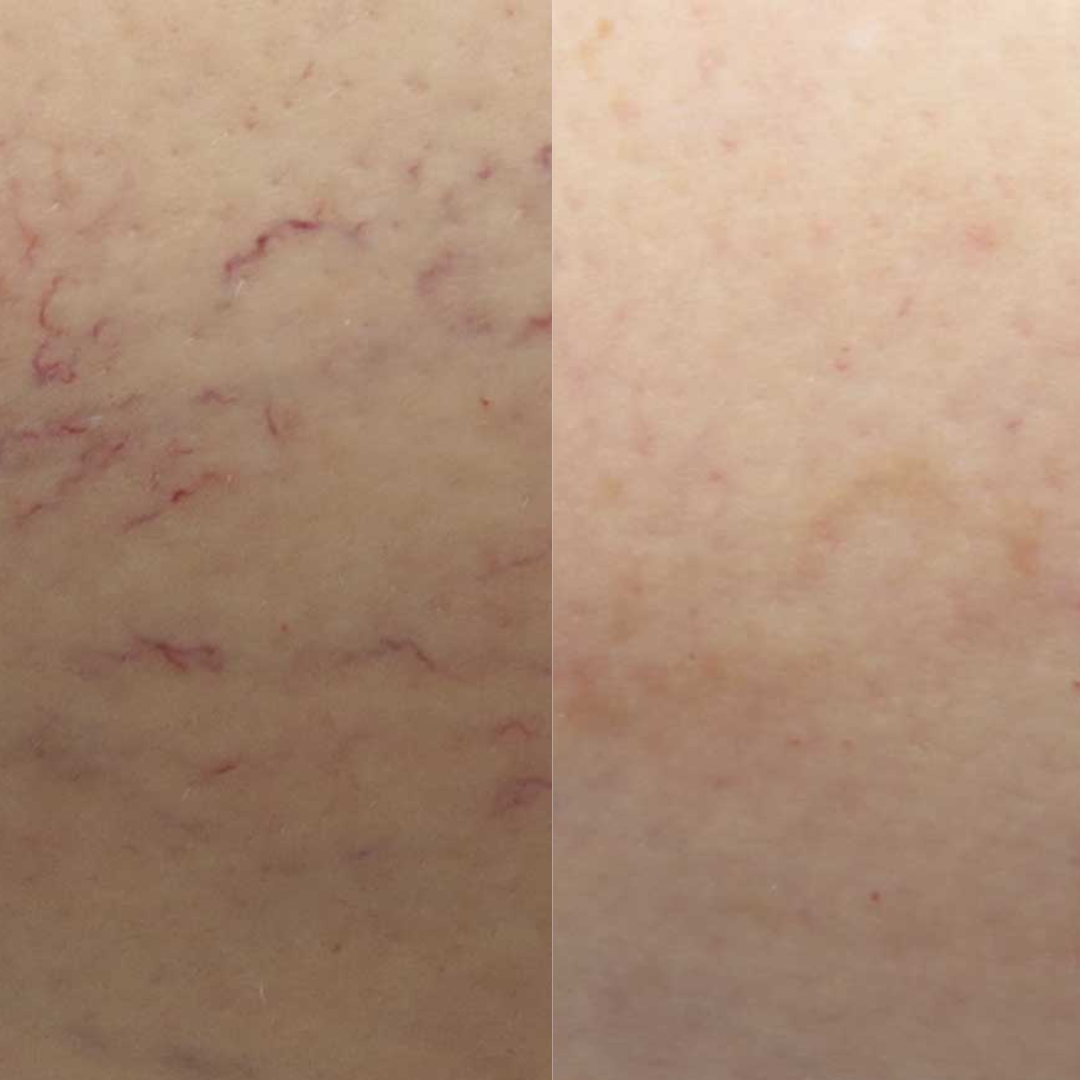 Derma Pro Fusion before and after result 4