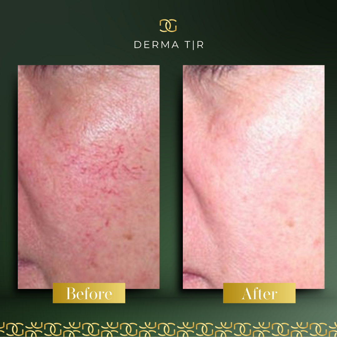 Derma Pro Fusion before and after result 4