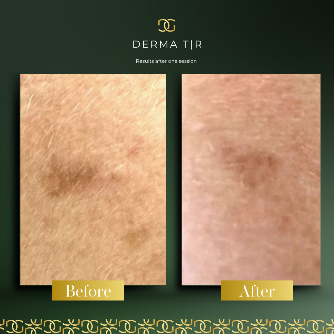 Derma Pro Fusion before and after result 4