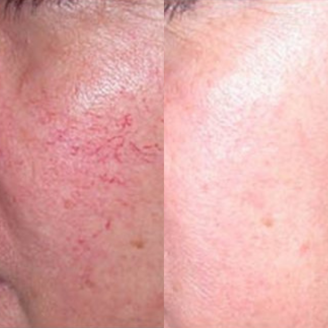 Derma Pro Fusion before and after result 4