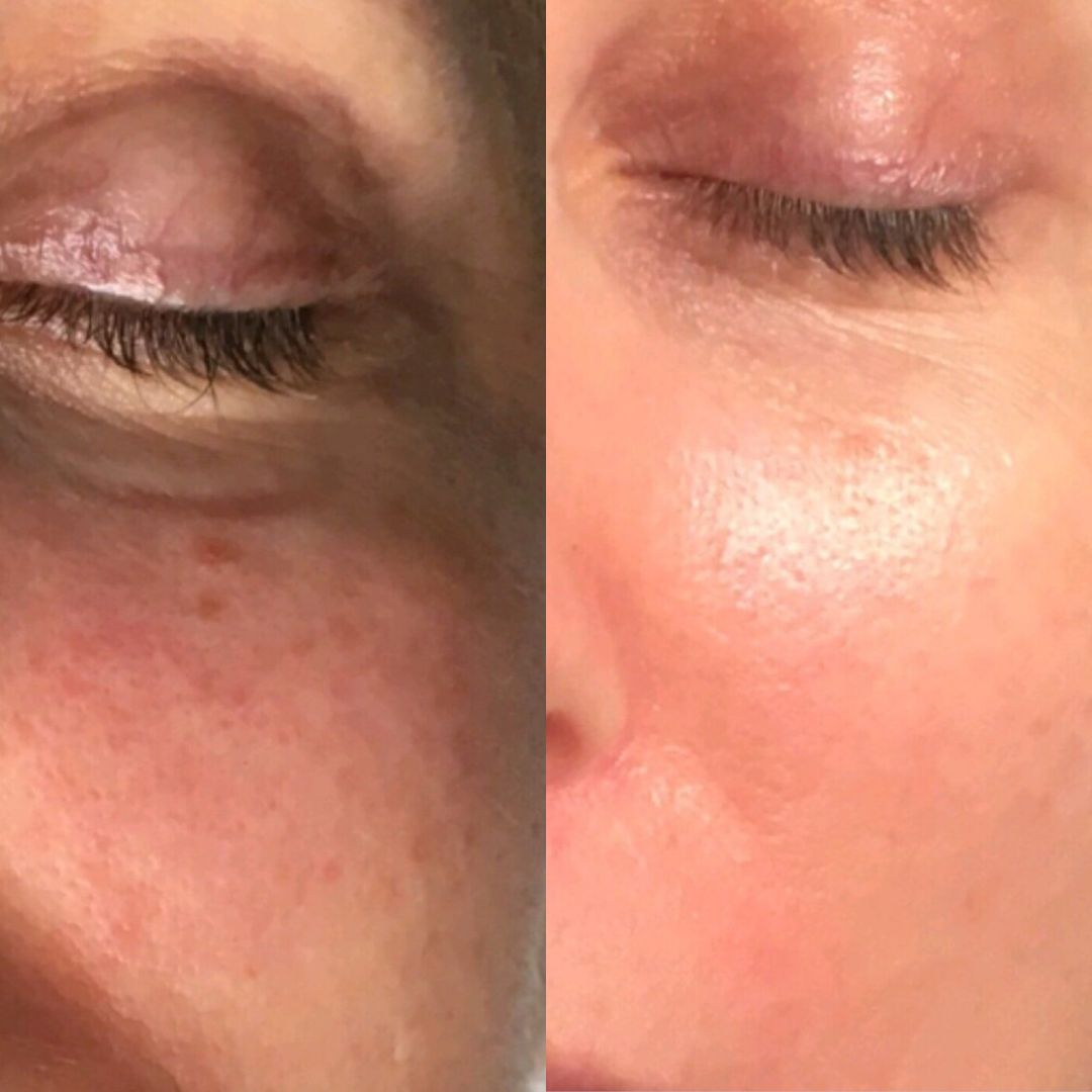 Derma Pro Fusion before and after result 3