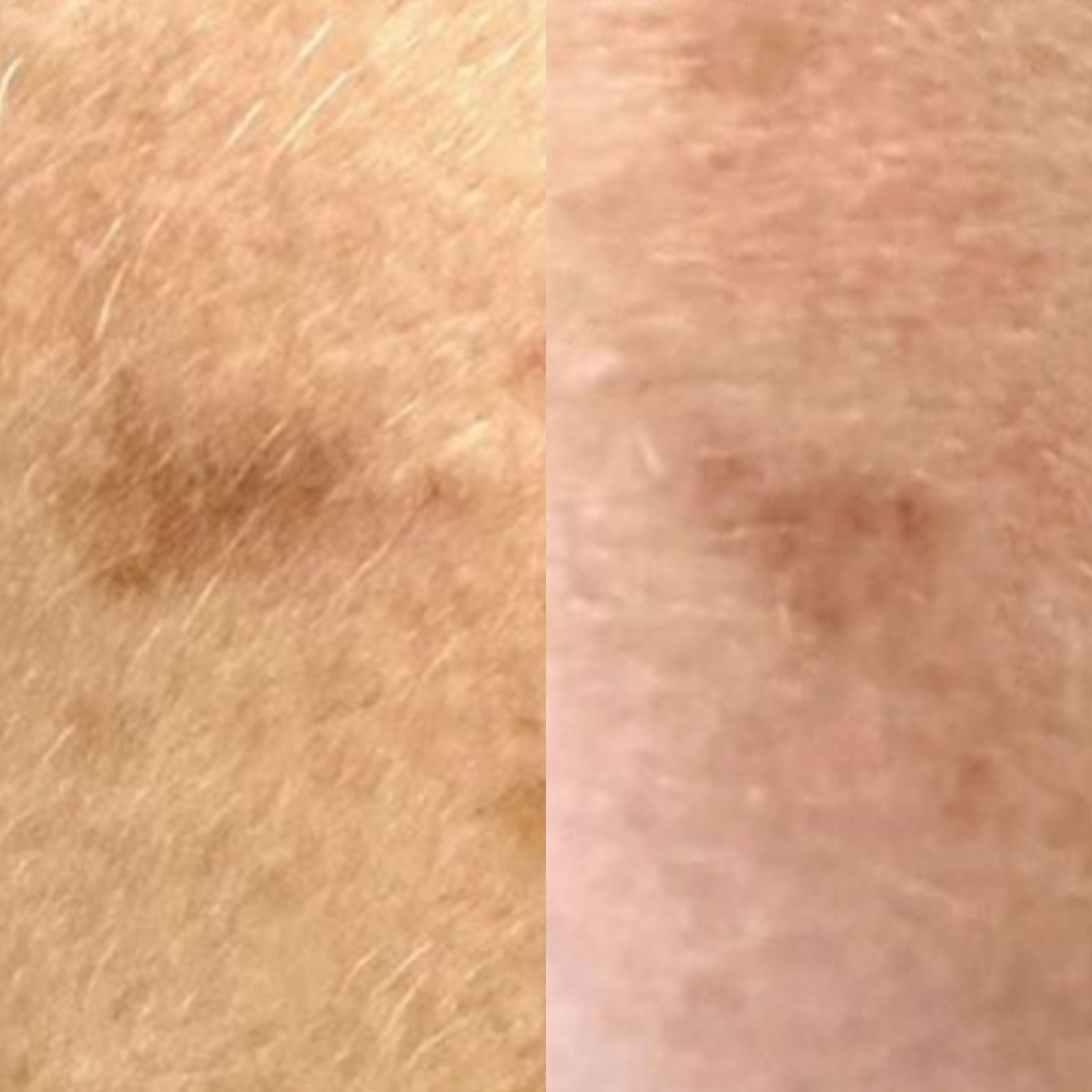 Derma Pro Fusion before and after result 4