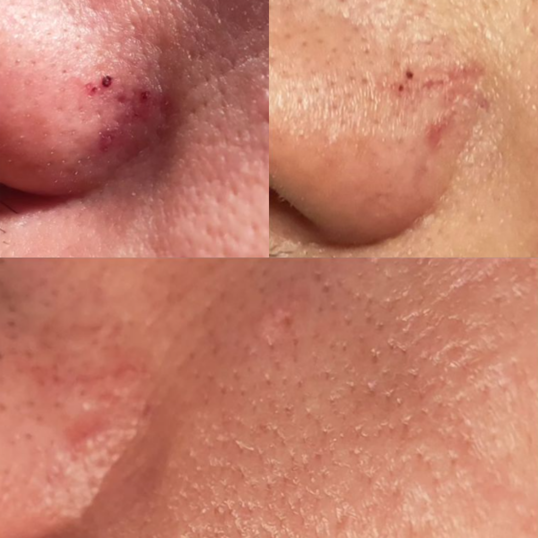 Derma Pro Fusion before and after result 3