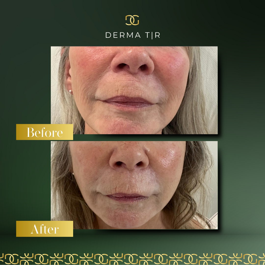 Derma Pro Fusion before and after result 4