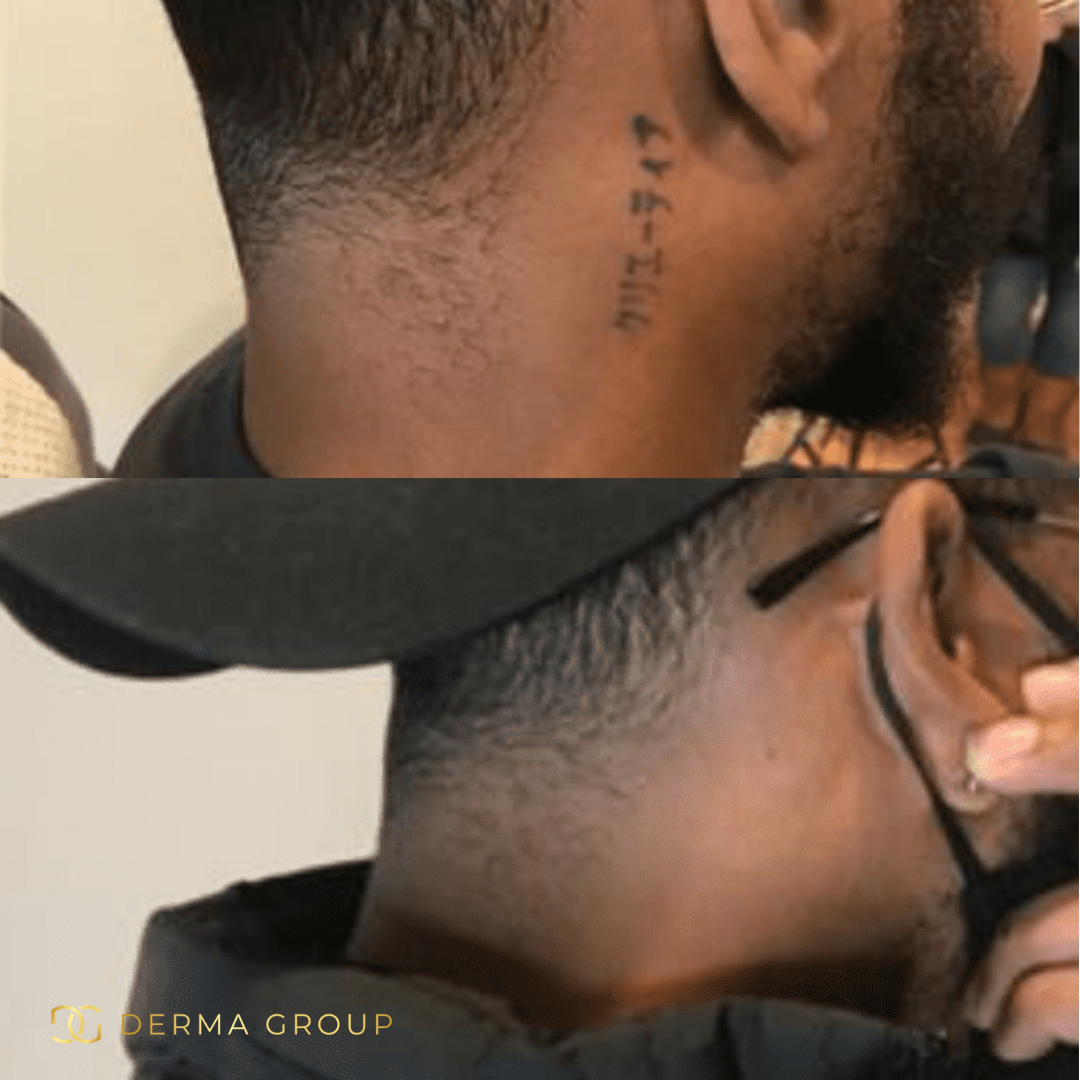 Derma Pro Fusion before and after result 3