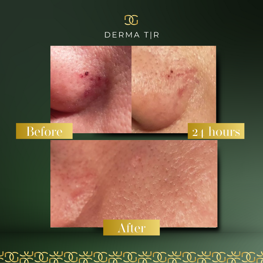 Derma Pro Fusion before and after result 4