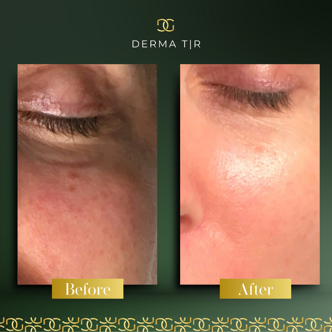 Derma Pro Fusion before and after result 2
